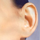 Korekcja uszu (Otoplastyka)